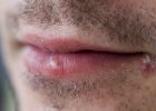 lutter-contre-herpes-buccal
